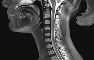脊髓“图谱”有望为损伤患者开发新治疗方法